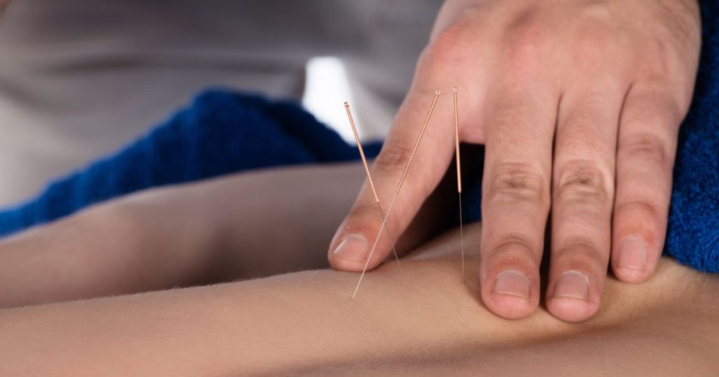 Top 3 Benefits of Acupuncture for People who have Endometriosis!